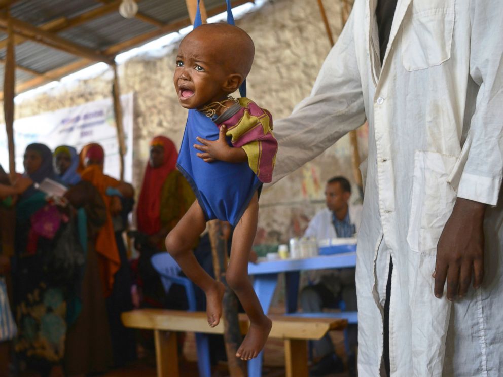 MALNUTRITION CHILD