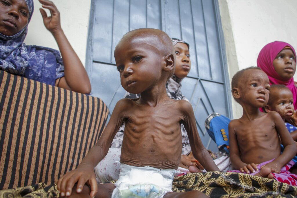MULNUTRITION CHILDREN